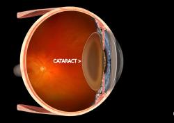 Cataracts & New Technology