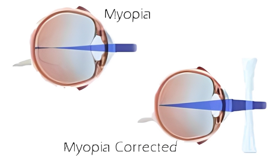 Common Vision Problems