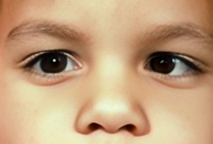 Strabismus